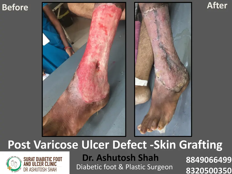 Varicose veins and Ulcers.pptx-4.webp